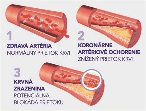 Súbor aterosklerotických zmien počas jednotlivých štádií rozvoja aterosklerózy