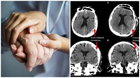 Ilustračná fotografia zdravého mozgu