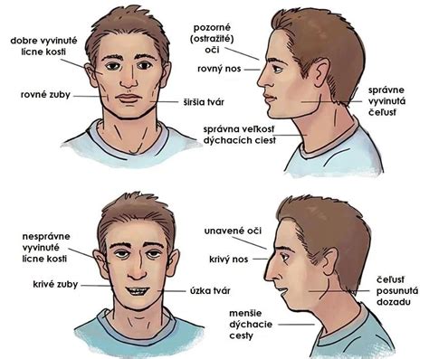 Infografika ukazujúca rozdiely vo vývoji tváre u detí dýchajúcich nosom a ústami