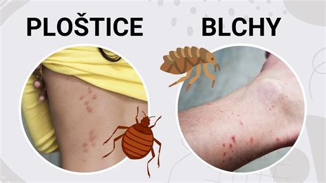 Štípance od ploštíc v rade