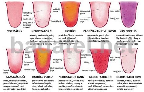 Obrázok zdraveho jazyka a jazyka s povlakom