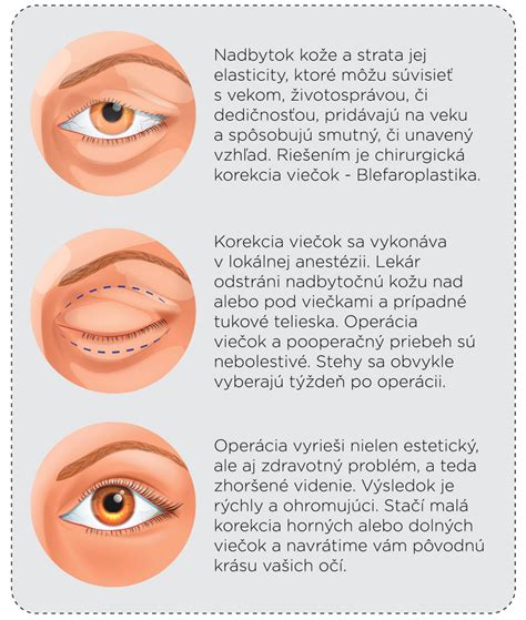 Ilustrácia očného viečka s ekzémom