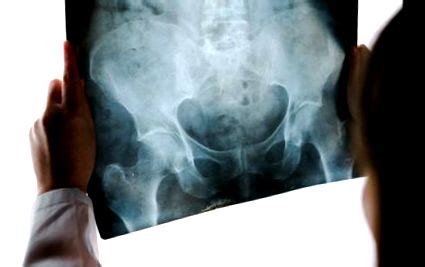 RTG snímka bedrového kĺbu s osteoartrózou