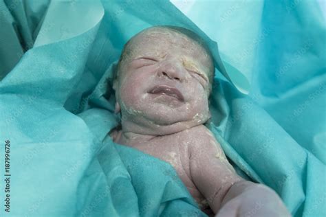 Vernix caseosa na novorodencovi