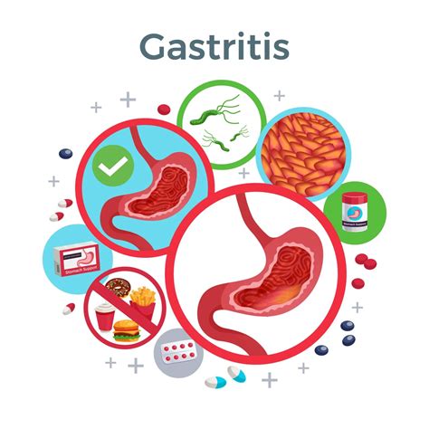 Infografika zakázaných potravín pri gastritíde