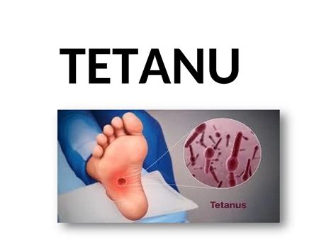 Ilustrácia príznakov tetanu