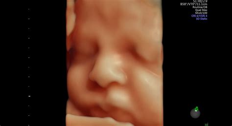 Ultrazvukové zobrazenie hlavičky plodu v 37. týždni