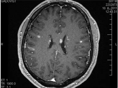 MRI mozgu s vyznačeným krvácaním