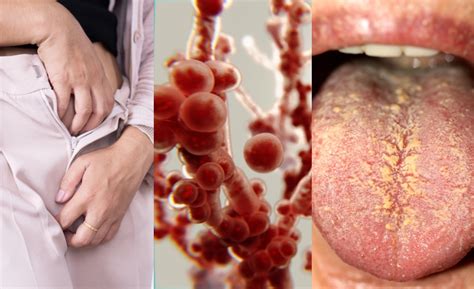 Ilustrácia kvasinkovej infekcie v ústach bábätka