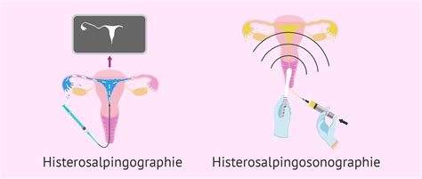 porovnanie RTG hysterosalpingografie a HyCoSy