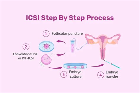 Schéma priebehu IVF