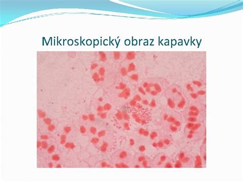 Mikroskopický obraz choriónových klkov s chorangiózou