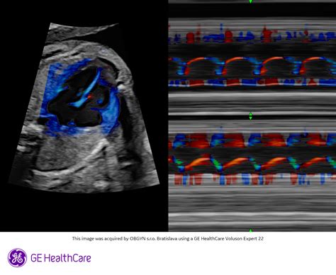ultrazvukové vyšetrenie maternice a vaječníkov