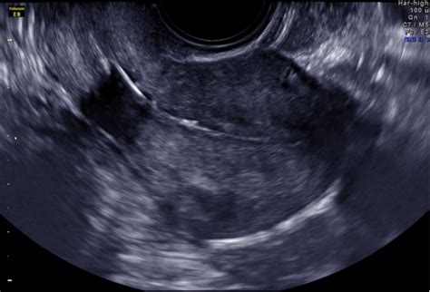 porovnanie metód vyšetrenia priechodnosti vajíčkovodov