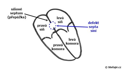 Schéma defektu komorového septa