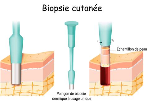 Schéma biopsie embrya