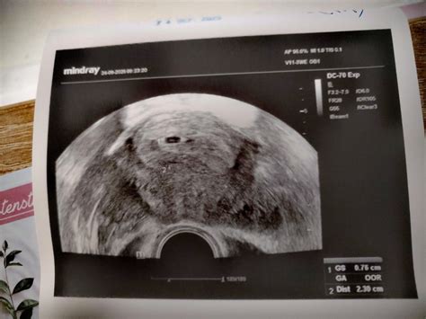 ultrazvukové zobrazenie embrya v 5. týždni tehotenstva