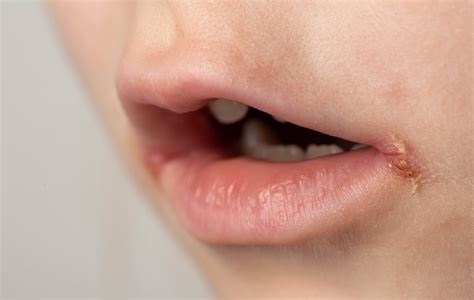 Deti s herpesom v ústach