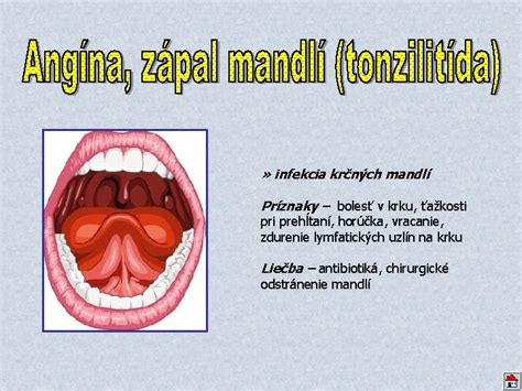 Ilustrácia mandlí a ich umiestnenia v krku