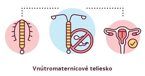 Infografika znázorňujúca možné komplikácie vnútromaternicového telieska