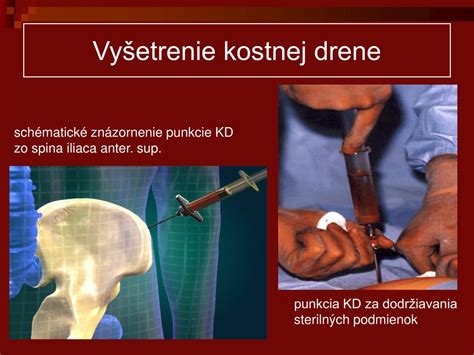 Schematické znázornenie kostnej drene