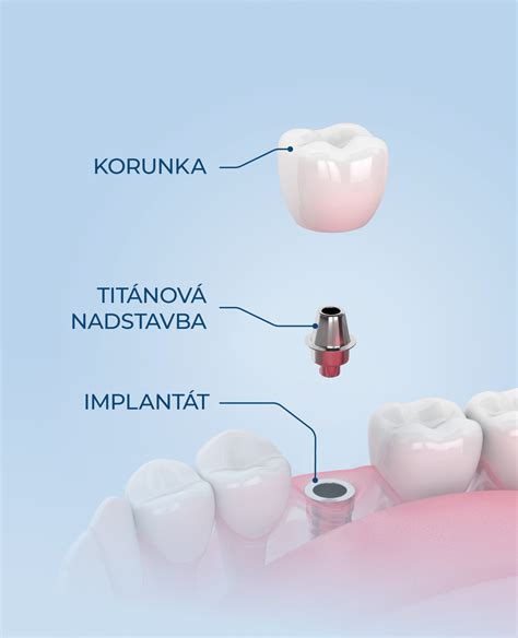 Ilustrácia funkcie kochleárneho implantátu