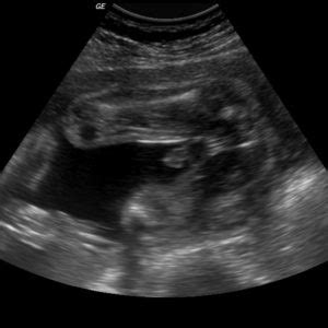 ultrazvukové zobrazenie plodu