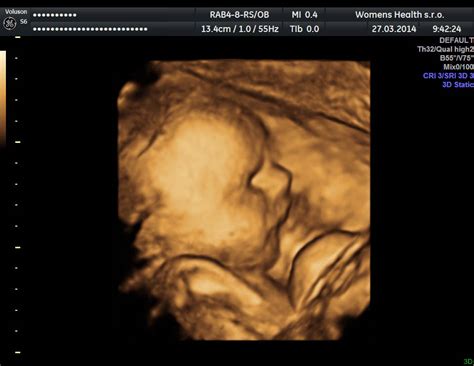 3D ultrazvukové zobrazenie tváre bábätka
