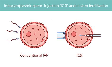 Ilustrácia IVF a ICSI metódy