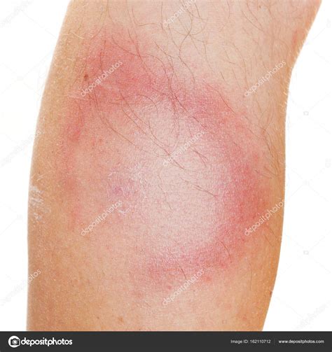 Příznaky lymské boreliózy - erythema migrans