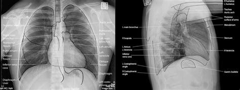 RTG snímka pľúc s pneumóniou