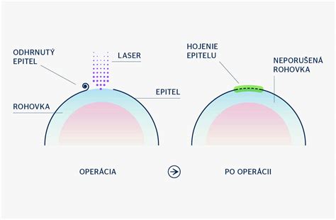 Schematické znázornenie fungovania excimerového lasera pri úprave rohovky