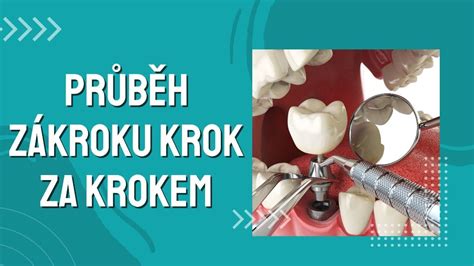 Schéma priebehu zákroku