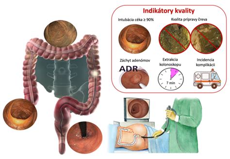 Ilustrácia prípravy na kolonoskopiu