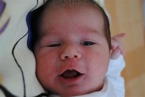 Ilustrácia tváre bábätka s ekzémom