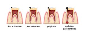 Ilustrácia vývoja zubného podnebia a ďasien dieťaťa