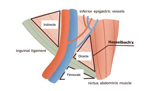 Anatomická schéma hernie