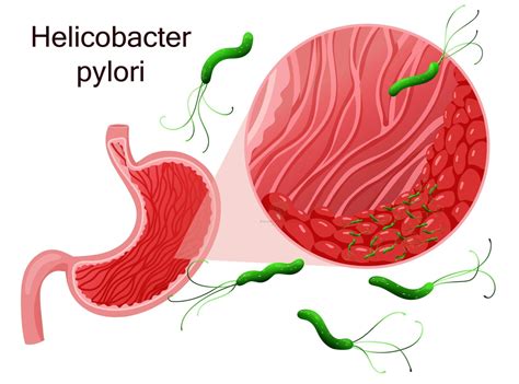 Schéma baktérie Helicobacter pylori v žalúdočnej sliznici