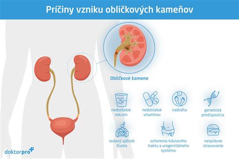 Schematické znázornenie obličiek a obličkových kameňov