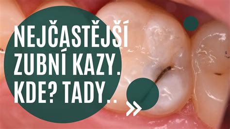 Porovnanie zdravého a pokazeného mliečneho zuba