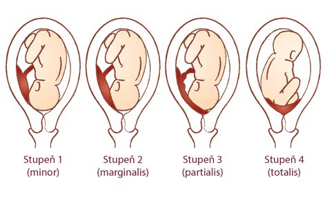 Schematické znázornenie vývoja placenty pri molárnom tehotenstve