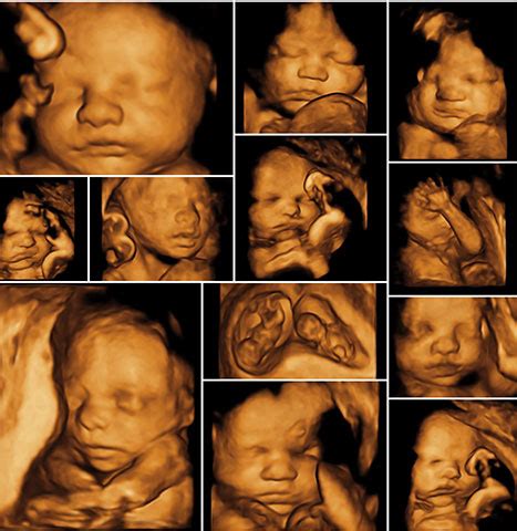 3D ultrazvuk mozgu plodu